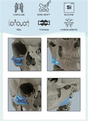 Balancing beauty and science: a review of facial implant materials in craniofacial surgery